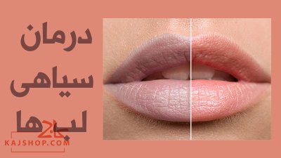 درمان سیاهی لب؛ {بیش از 12 روش موثر برای روشن سازی و رفع تیرگی لب}